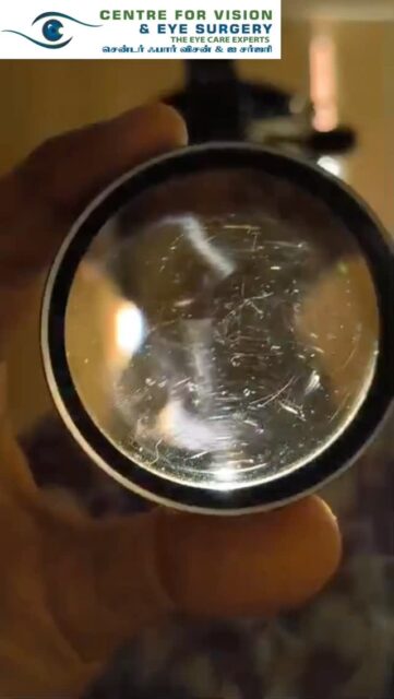 *Can a 1.5-year-old child have high eye power?  Yes — and it should never be ignored.*

In very young children, vision problems often go unnoticed because they cannot express what they see. In this case, retinoscopy showed a high refractive error. Since the child was not cooperative for detailed evaluation, an Examination Under Anaesthesia was performed to accurately measure the power and thoroughly examine the retina.

Every child is different. Some cooperate, some don’t. What matters most is early diagnosis and timely intervention to ensure proper visual development.

✨ Early detection can protect your child’s vision for life.

If you notice poor eye contact, unusual eye movements, or delayed visual response in your child — consult a pediatric eye specialist early.

#PediatricOphthalmology #ChildEyeCare #KidsVision #EarlyDetection #AmblyopiaAwareness HighMyopia EyeCheckup Retinoscopy ExaminationUnderAnaesthesia ParentAwareness HealthyVision CentreForVision DrLipikaRoy ProtectLittleEyes