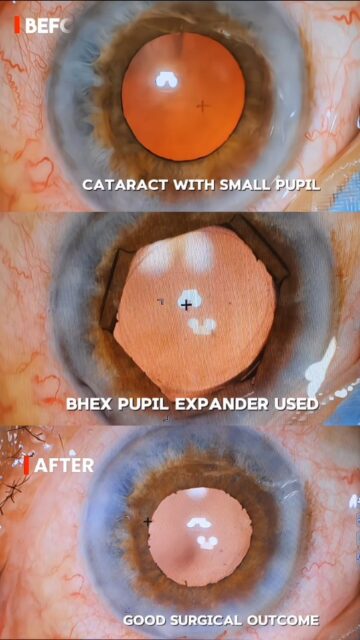 Small pupil? No problem. 👁️✨
In the skilled hands of Dr. Anand Parthasarathy, even challenging cataract cases can be managed safely and effectively. Using a B-HEX pupil expander, optimal surgical visibility was achieved, allowing precise cataract removal and a smooth intraocular lens implantation. The result — a stable surgery and an excellent visual outcome for the patient.

#DrAnandParthasarathy #CataractSurgery #Ophthalmology #EyeSurgery #BHEX SmallPupil SurgicalExcellence VisionCare EyeHospital BetterVision EyeHealth Microsurgery Ophthalmologist PatientCare AdvancedTechnology ClearVision