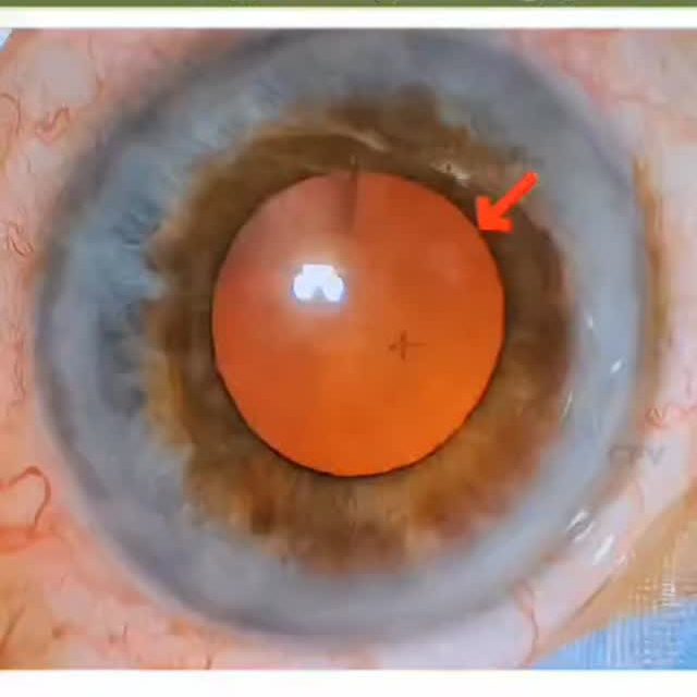 சிறிய pupil இருந்தாலே சிக்கலா? கவலை வேண்டாம் 👁️✨
Dr. ஆனந்த் பார்த்தசாரதி அவர்களின் திறமையான கைகளில், சவாலான cataract surgery கூட பாதுகாப்பாகவும் துல்லியமாகவும் செய்ய முடியும். B-HEX pupil expander பயன்படுத்தி சிறந்த பார்வை கிடைக்கச் செய்து, cataract நீக்கம் மற்றும் lens பொருத்துதல் மிகச் சிறப்பாக நடைபெற்றது.
இதன் விளைவு — பாதுகாப்பான அறுவை சிகிச்சை மற்றும் நோயாளிக்கு சிறந்த பார்வை மேம்பாடு.

#DrAnandParthasarathy #CataractSurgery #Ophthalmology #EyeSurgery #BHEX SmallPupil SurgicalExcellence VisionCare EyeHospital BetterVision EyeHealth Microsurgery Ophthalmologist PatientCare AdvancedTechnology ClearVision கண்_ஆரோக்கியம் கேட்டரக்ட் கண்_அறுவைசிகிச்சை சிறந்தபார்வை