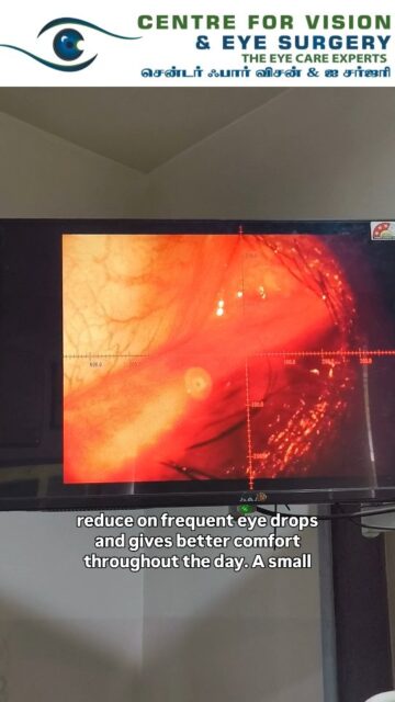 💧 Using eye drops all day… but still suffering from dry eyes?

What if the problem isn’t lack of tears… but losing them too quickly? 👁️

Punctal plugs are a simple, non-surgical solution that help your eyes retain natural tears for longer, giving lasting relief from dryness, irritation, and burning.

🔹 Quick in-clinic procedure
🔹 No surgery, no downtime
🔹 Temporary & permanent options available
🔹 Ideal when drops alone aren’t enough

✨ Less drops… more natural comfort.

👁️ Sometimes, a tiny plug can make a big difference.
#DryEye #PunctalPlug #DryEyeRelief #EyeCare #Ophthalmology EyeDoctor HealthyEyes VisionCare ScreenTimeStrain ContactLensProblems MedicalReels ChennaiDoctors EyeClinic TearFilm NoMoreDryEyes EyeTips ReelEducation DoctorReels EyeHealthAwareness