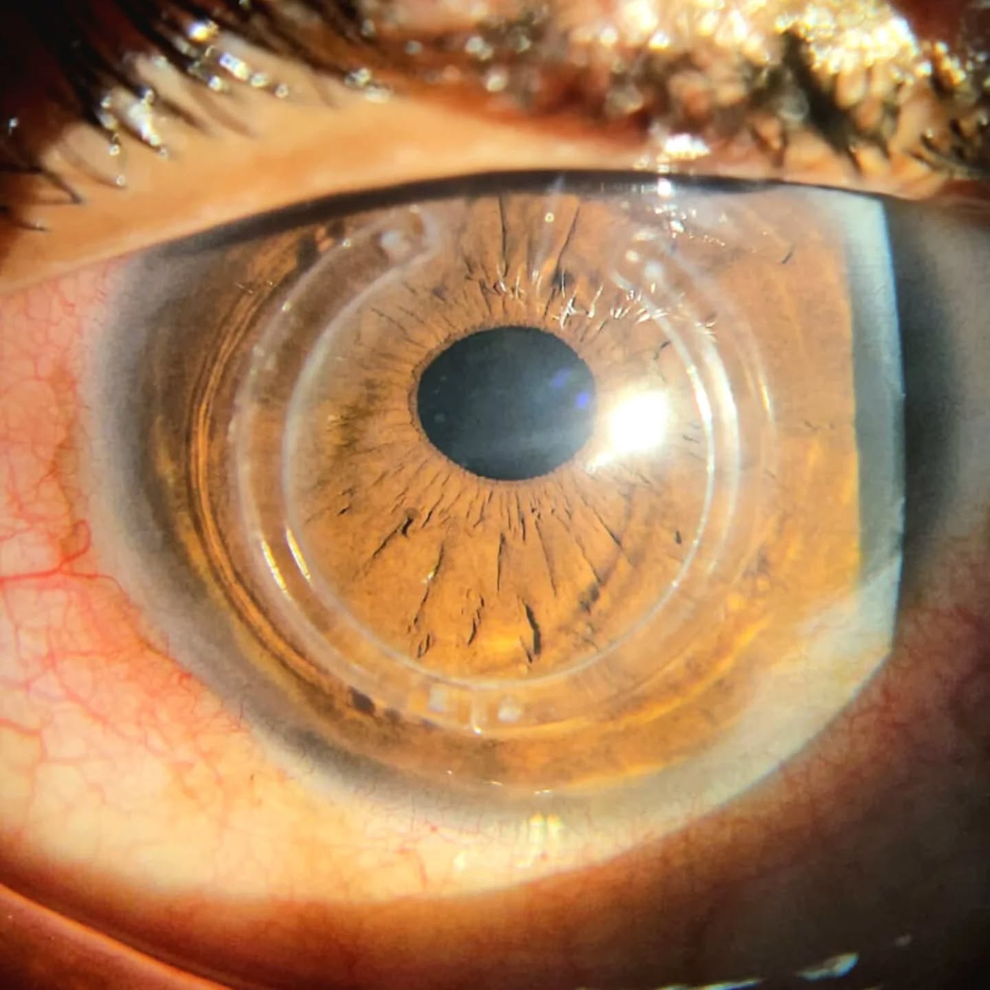 THE SPOILER NO ONE TELLS YOU: You Don’t Always Need a Transplant! 👁️🚫
​Here is the "naked" truth about Keratoconus: Many are told a cornea transplant is inevitable, but early intervention changes everything.
​The 12-Year Verdict: At 18, vision was fading and the "cone" was bulging. The choice? Intracorneal Rings (ICRS). Now, at 30, the results are clear. Those tiny inserts did what seemed impossible: they stopped the clock.
​The Raw Facts:
​No Donor Needed: We reinforced the natural cornea instead of replacing it.
​Total Stability: 12 years of crisp vision without the high-risk complications of a full transplant.
​The "Gap" Closed: By flattening the cornea early, we bypassed the surgical point of no return.
​The ultimate spoiler? Early intervention is the cure for fear. 12 years later, the rings are still winning. Don't wait for the blur to win—save your natural sight! 🚀
​#Keratoconus #EyeSurgery #NoTransplant #KeratoconusWarrior #ICRS EyeHealth SaveYourSight CorneaHealth RefractiveSurgery VisionStability