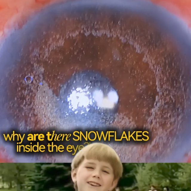 👁️❄️ “Snowflakes inside the eye?”
Looks magical… but it’s actually Silicone Oil in the Anterior Chamber 👀

Silicone oil is commonly used after retinal surgery to help protect vision and support healing. But sometimes, the oil can move to the front part of the eye and may lead to blurred vision, pressure rise, or corneal damage if not monitored properly.

✨ What looks visually satisfying on camera can actually be an important eye finding.

Your eyes always give signs — don’t ignore them ❤️
Regular follow-ups after eye surgery are just as important as the surgery itself.

📍At Centre for Vision, we focus on early detection, expert care, and protecting your sight.

DM US FOR CONSULTATION AND APPOINTMENT BOOKINGS 

Centre for vision and eye surgery branches:
📞 Sholinganallur – 9840092647
📞 Medavakkam – 9500048895
📞 Navalur – 8754454767
📞 Kelambakkam – 9789894157
📞 Kalpakkam – 9363406268

#ophthalmology #SiliconeOil #EyeCare #RetinaCare #optometry EyeAwareness CentreForVision VisionCare MedicalReels Ophthalmology EyeHealth