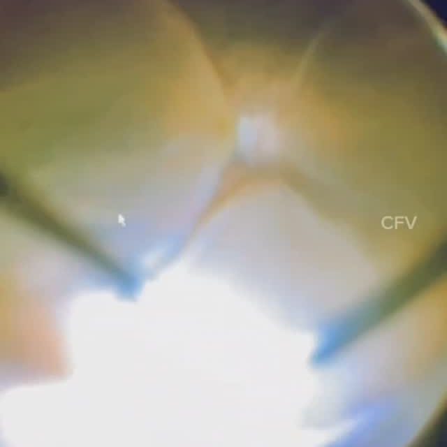 Before the world wakes up ,we already save the vision 😍

#ophthalmology #optometry #eyehealth #eyehoapital
