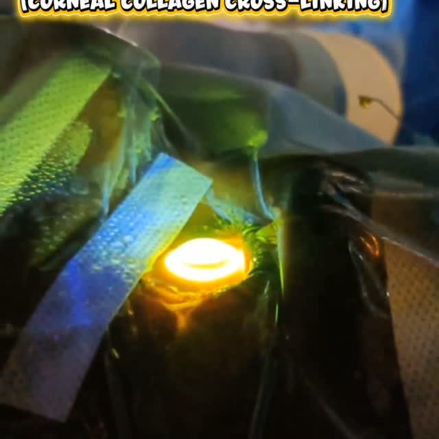 👁️✨ How do we strengthen a weakened cornea?

Keratoconus is a progressive corneal condition where the cornea becomes thin and weak, affecting the quality of vision.

Laser-Assisted C3R (Corneal Collagen Cross-Linking) is an advanced procedure designed to strengthen the cornea and help slow the progression of keratoconus.

🔹 Laser-assisted corneal preparation
🔹 Riboflavin (Vitamin B2) application
🔹 UVA light activation for collagen cross-linking

💙 Advancing corneal care with precision, technology, and expertise.

Centre for Vision and Eye Surgery

📍 Sholinganallur – 9840092647
📍 Medavakkam – 9500048895
📍 Navalur – 8754454767
📍 Kelambakkam – 9789894157
📍 Kalpakkam – 9363406268

#LaserAssistedC3R #CornealCrossLinking #Keratoconus #corneacare #ophthalmology CentreForVisionAndEyeSurgery

Treatment suitability depends on individual eye evaluation by an eye specialist.